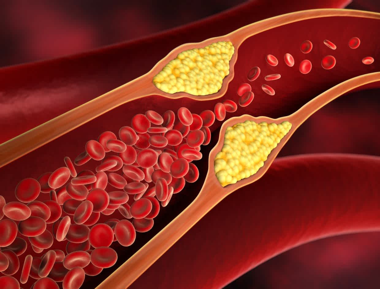 High Cholesterol